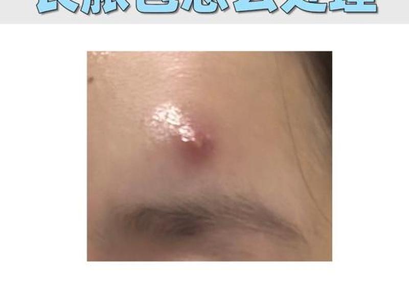 18岁女孩背后有脓包怎么回事、18岁女孩背后有脓包怎么回事啊 18岁女孩背后有脓包怎么回事、18岁女孩背后有脓包怎么回事啊