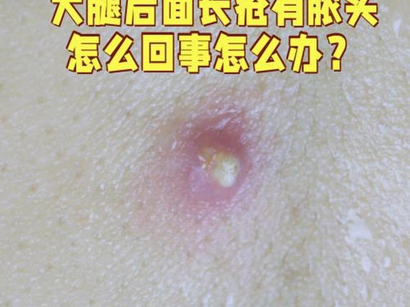 18岁女孩背后有脓包怎么回事,18岁女孩背后有脓包怎么回事啊 18岁女孩背后有脓包怎么回事,18岁女孩背后有脓包怎么回事啊