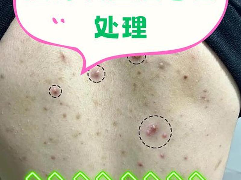 18岁女孩背后有脓包怎么回事、18岁女孩背后有脓包怎么回事啊 18岁女孩背后有脓包怎么回事、18岁女孩背后有脓包怎么回事啊